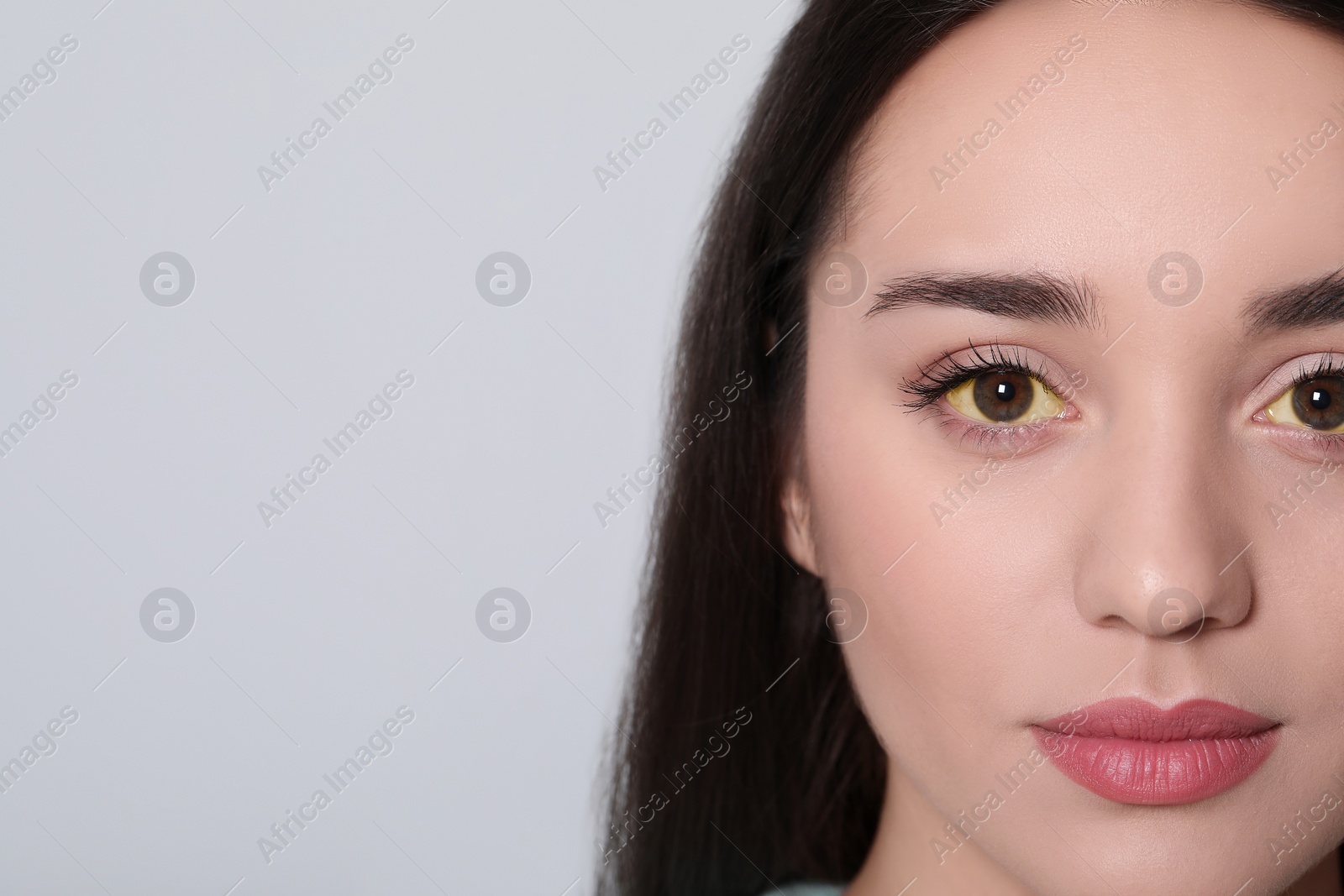 Photo of Woman with yellow eyes on white background, closeup. Symptom of hepatitis