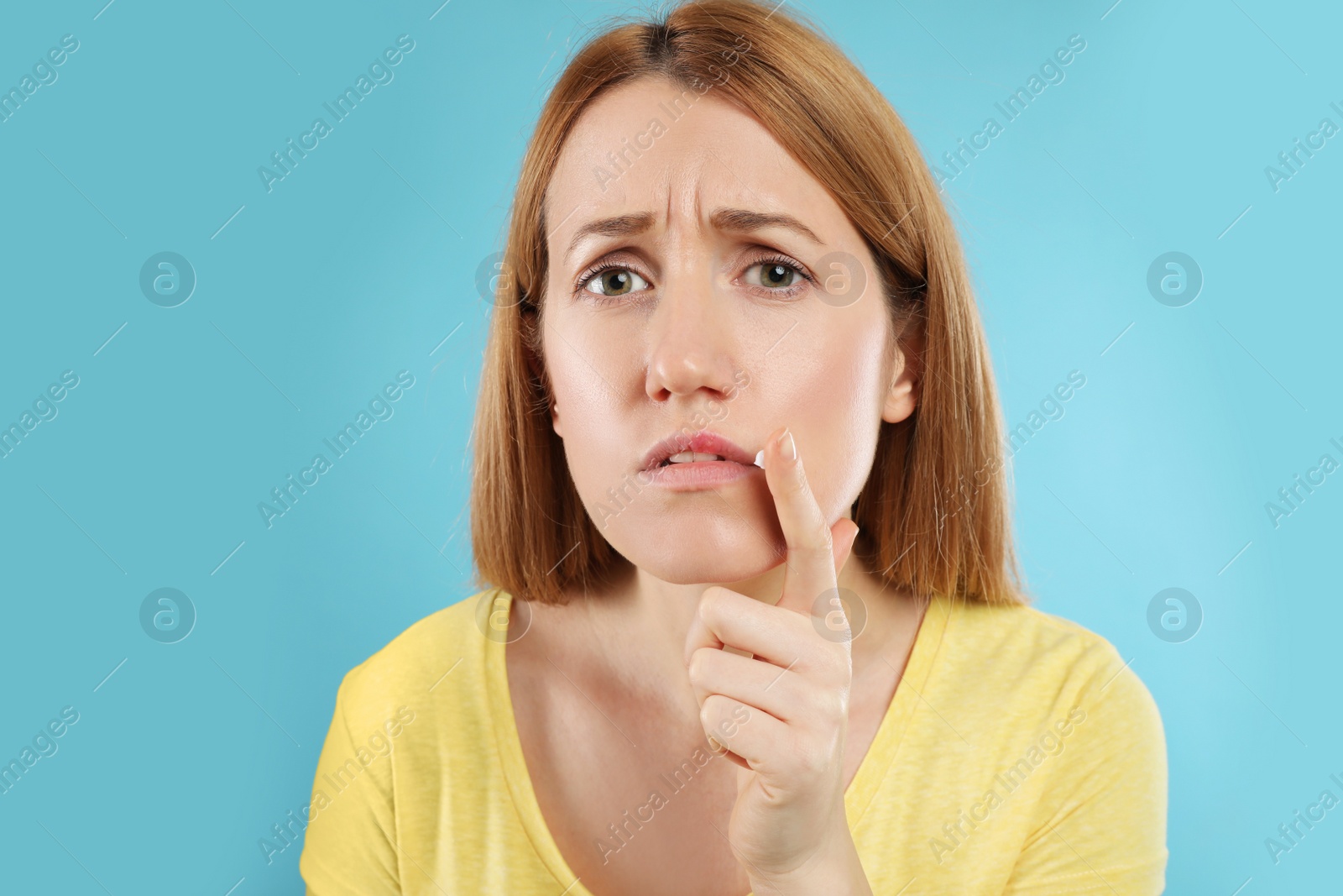 Photo of Upset woman with herpes applying cream on lips against light blue background