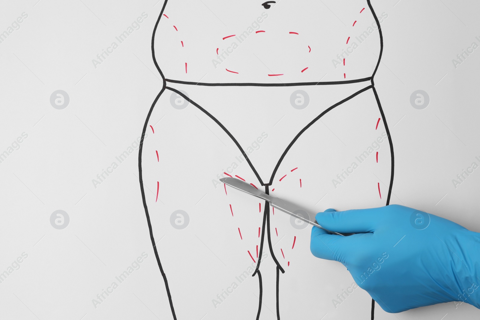 Photo of Doctor holding scalpel near drawn human body with marks on white background, top view. Weight loss surgery