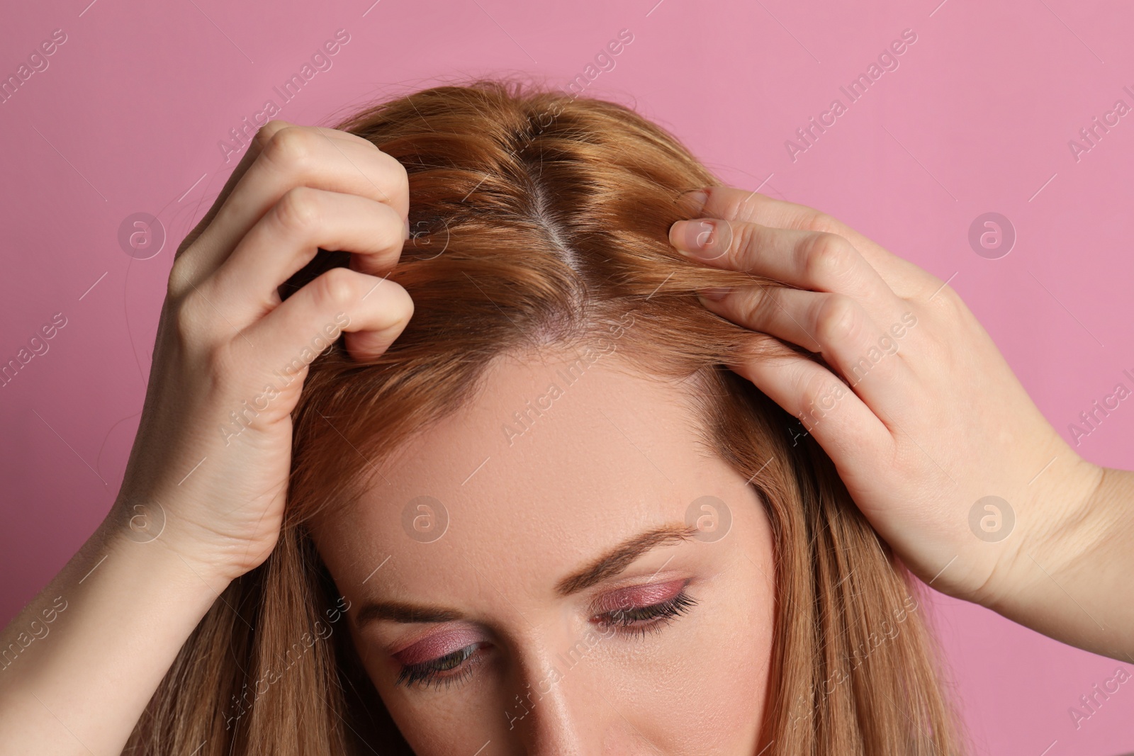 Photo of Woman suffering from baldness on pink background, closeup