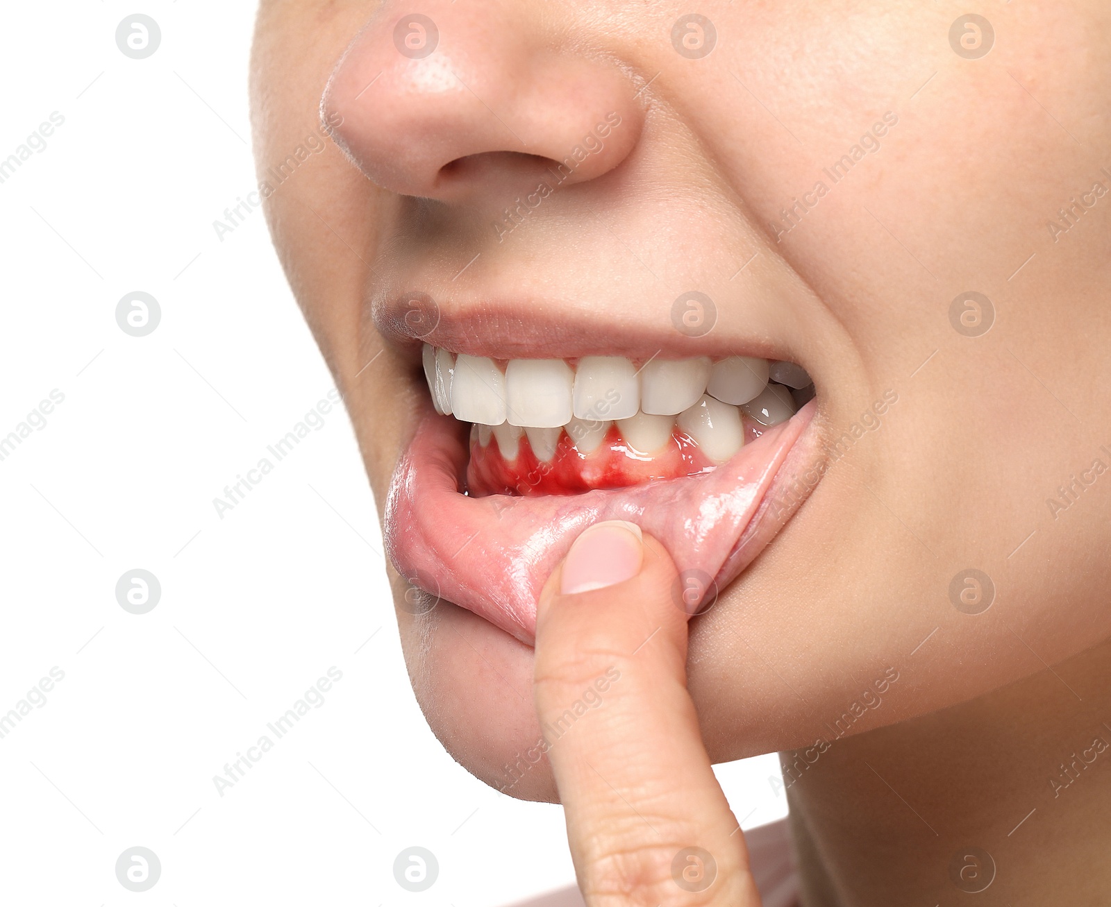 Image of Woman showing inflamed gum on white background, closeup