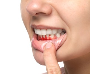 Woman showing inflamed gum on white background, closeup