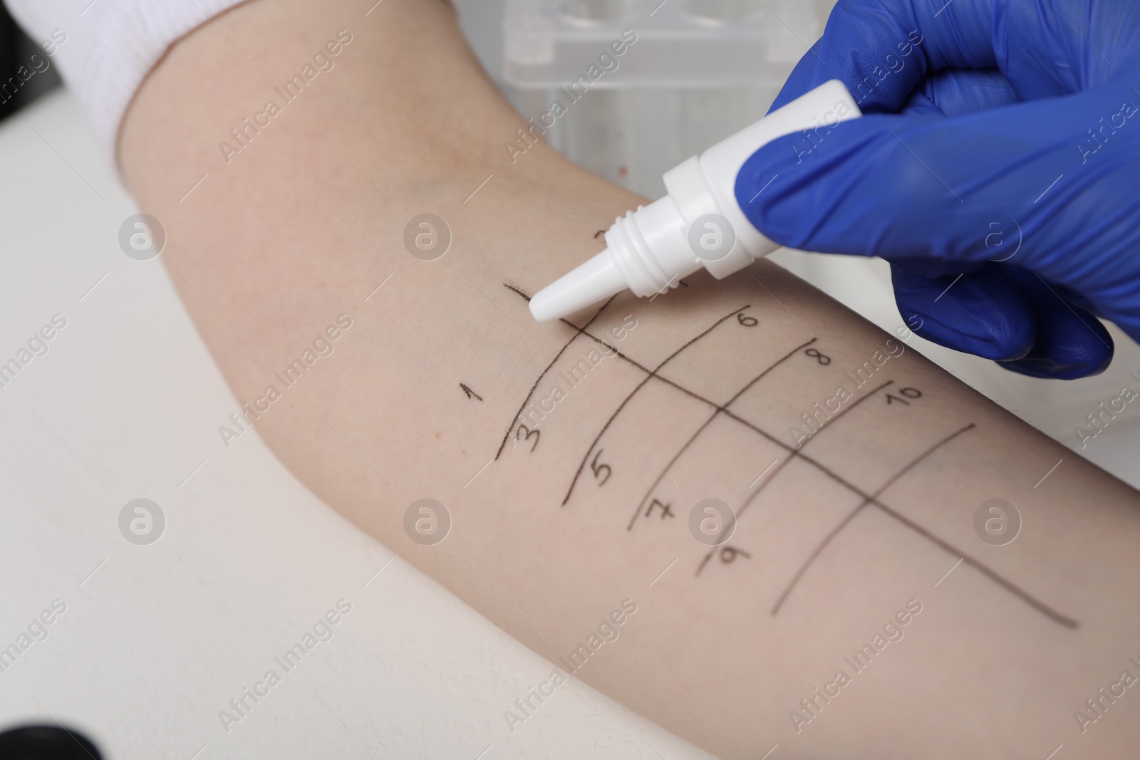 Photo of Doctor doing skin allergy test at light table, closeup