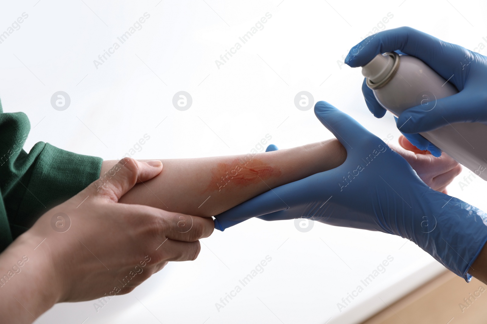 Photo of Applying burn spray onto injured skin, closeup