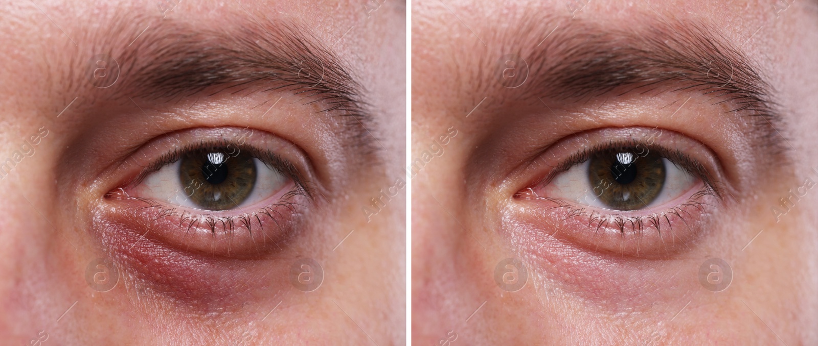 Image of Collage with photos of man with dark circle under eye before and after treatment, closeup