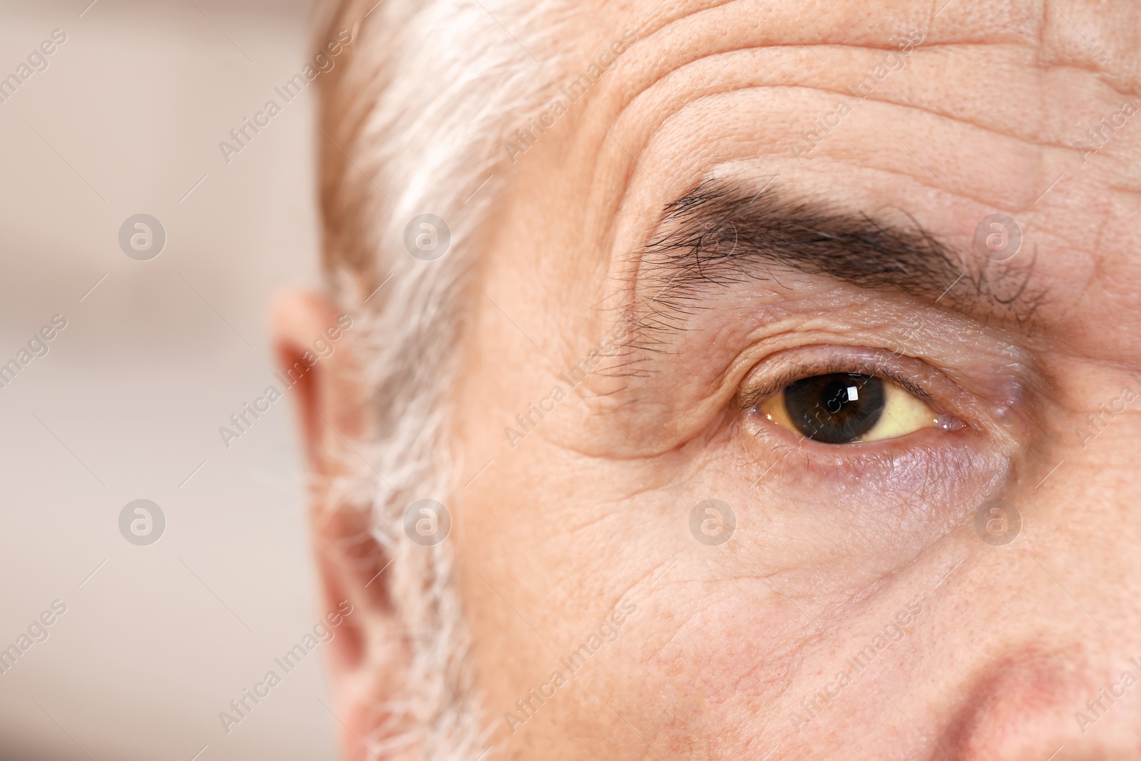 Photo of Senior man with yellow eyes on blurred background, closeup. Symptom of hepatitis