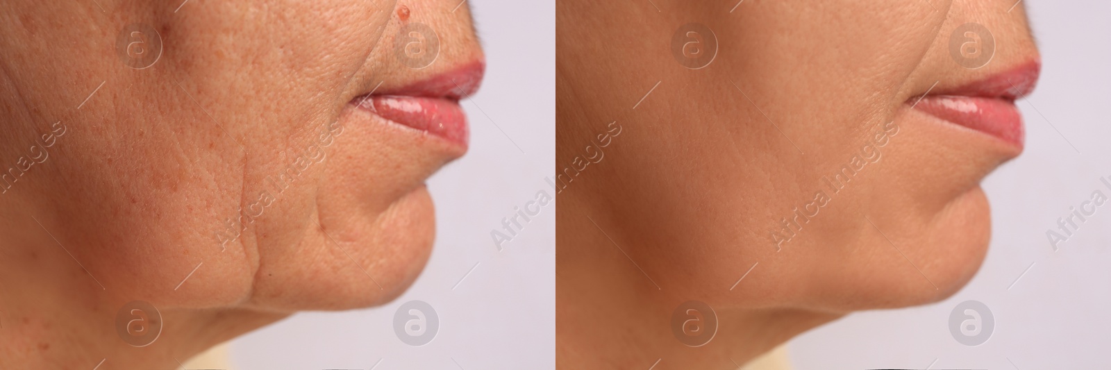 Image of Woman before and after rejuvenating procedures. Collage with photos on white background, closeup