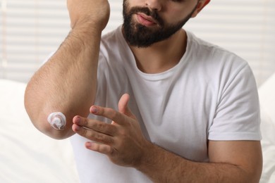 Man with dry skin applying cream onto his elbow on light background, closeup