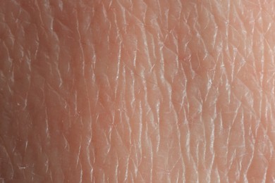 Photo of Texture of dry skin as background, macro view