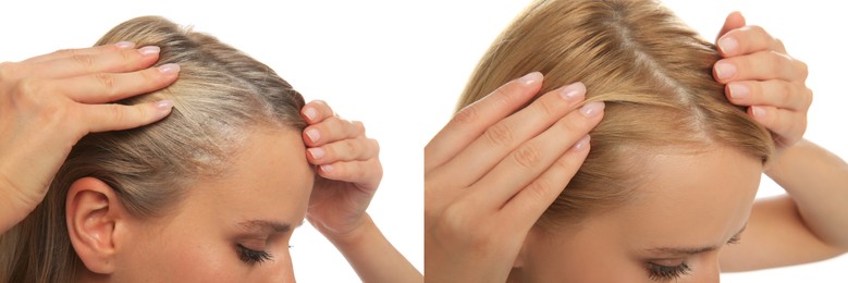 Image of Woman before and after hair treatment with high frequency darsonval device on white background, closeup. Collage of photos