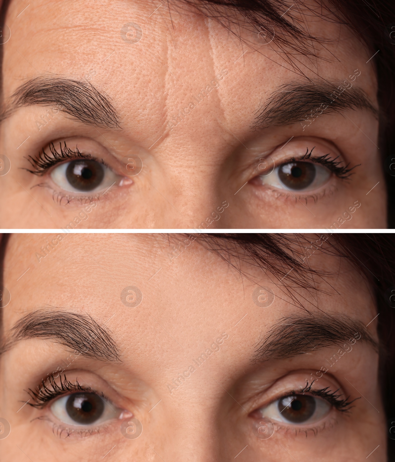 Image of Mature woman before and after skin tightening treatments. Collage with photos, closeup