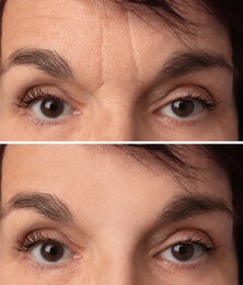 Mature woman before and after skin tightening treatments. Collage with photos, closeup