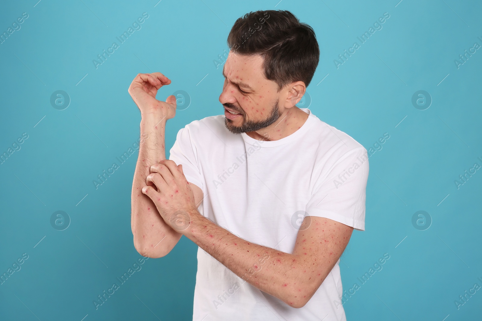 Photo of Man with rash suffering from monkeypox virus on light blue background