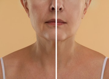 Aging skin changes. Woman showing neck before and after rejuvenation, closeup. Collage comparing skin condition