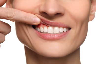 Image of Woman showing inflamed gum on white background, closeup