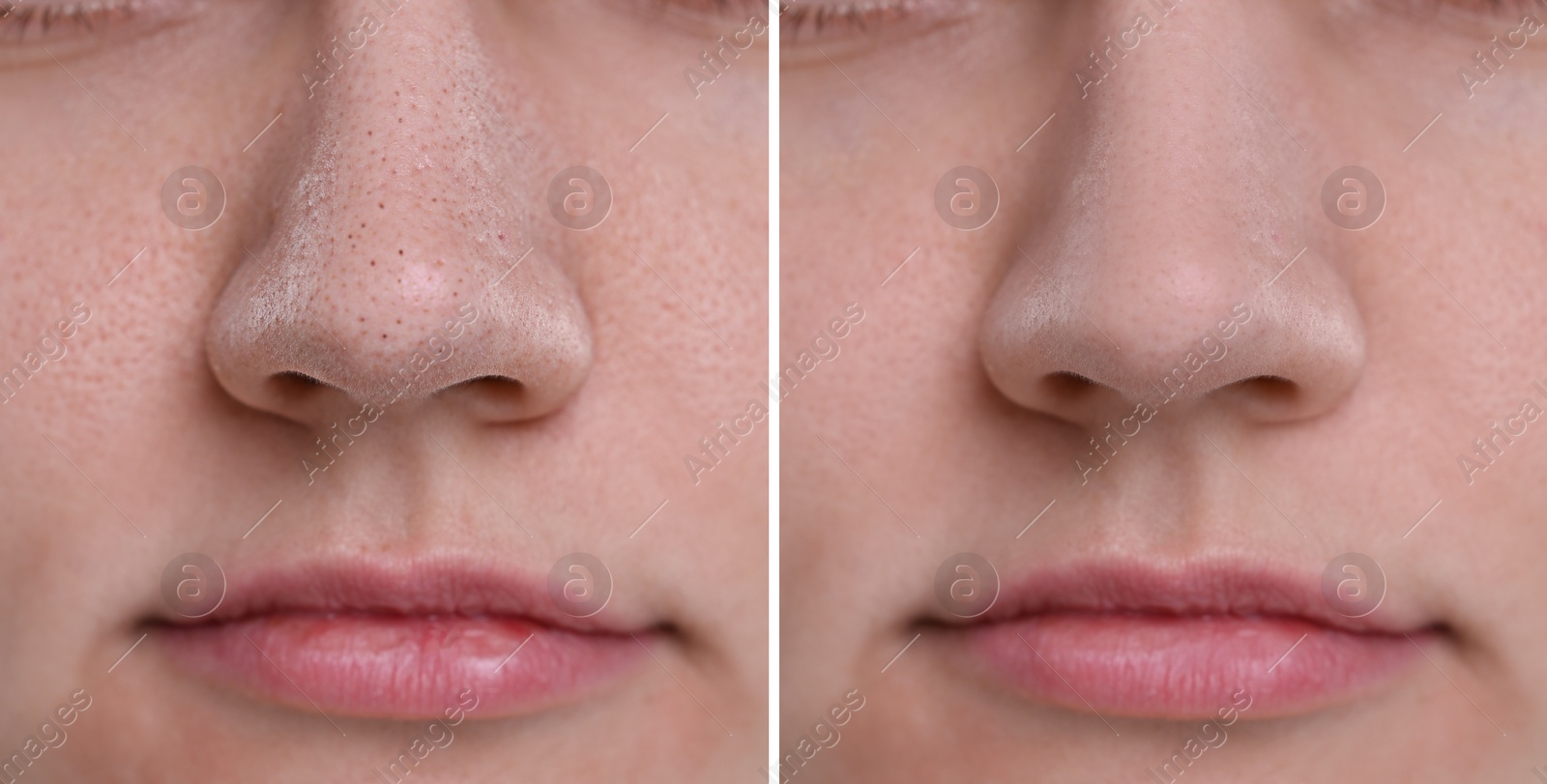 Image of Blackhead treatment, before and after. Collage with photos of woman, closeup view