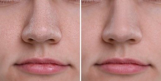 Blackhead treatment, before and after. Collage with photos of woman, closeup view