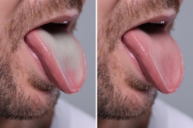 Image of Man showing his tongue before and after cleaning procedure, closeup. Tongue coated with plaque on one side and healthy on other, collage