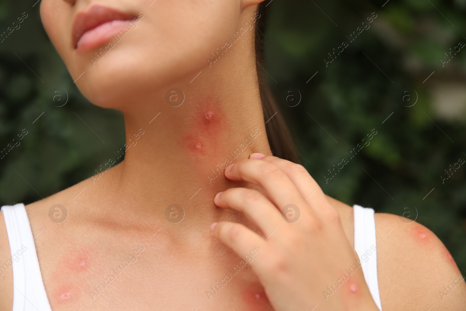 Photo of Woman scratching neck with insect bites outdoors, closeup