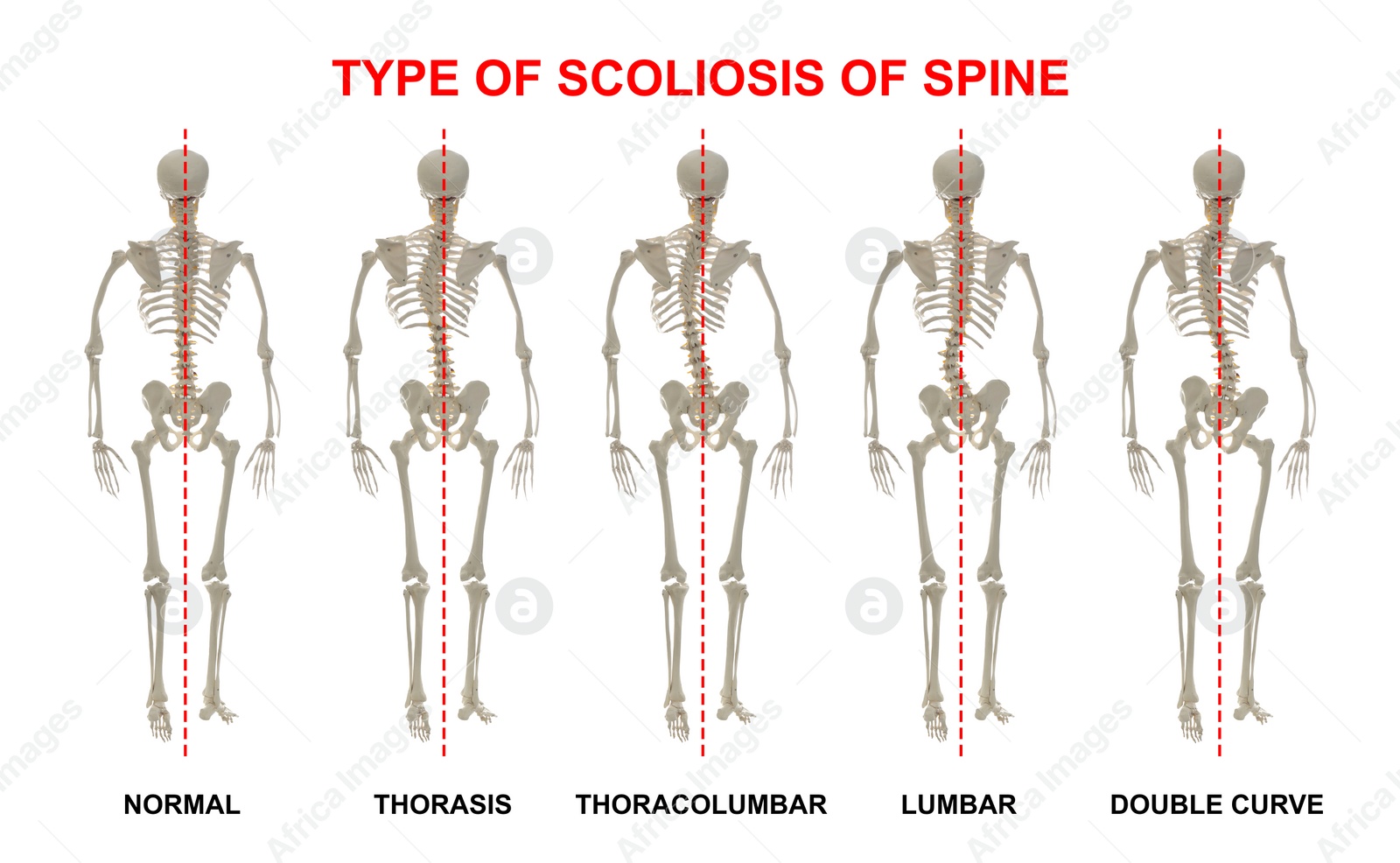 Illustration of Medical poster demonstrating types of scoliosis on white background.  healthy and diseased spine