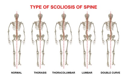 Medical poster demonstrating types of scoliosis on white background. Illustration of healthy and diseased spine