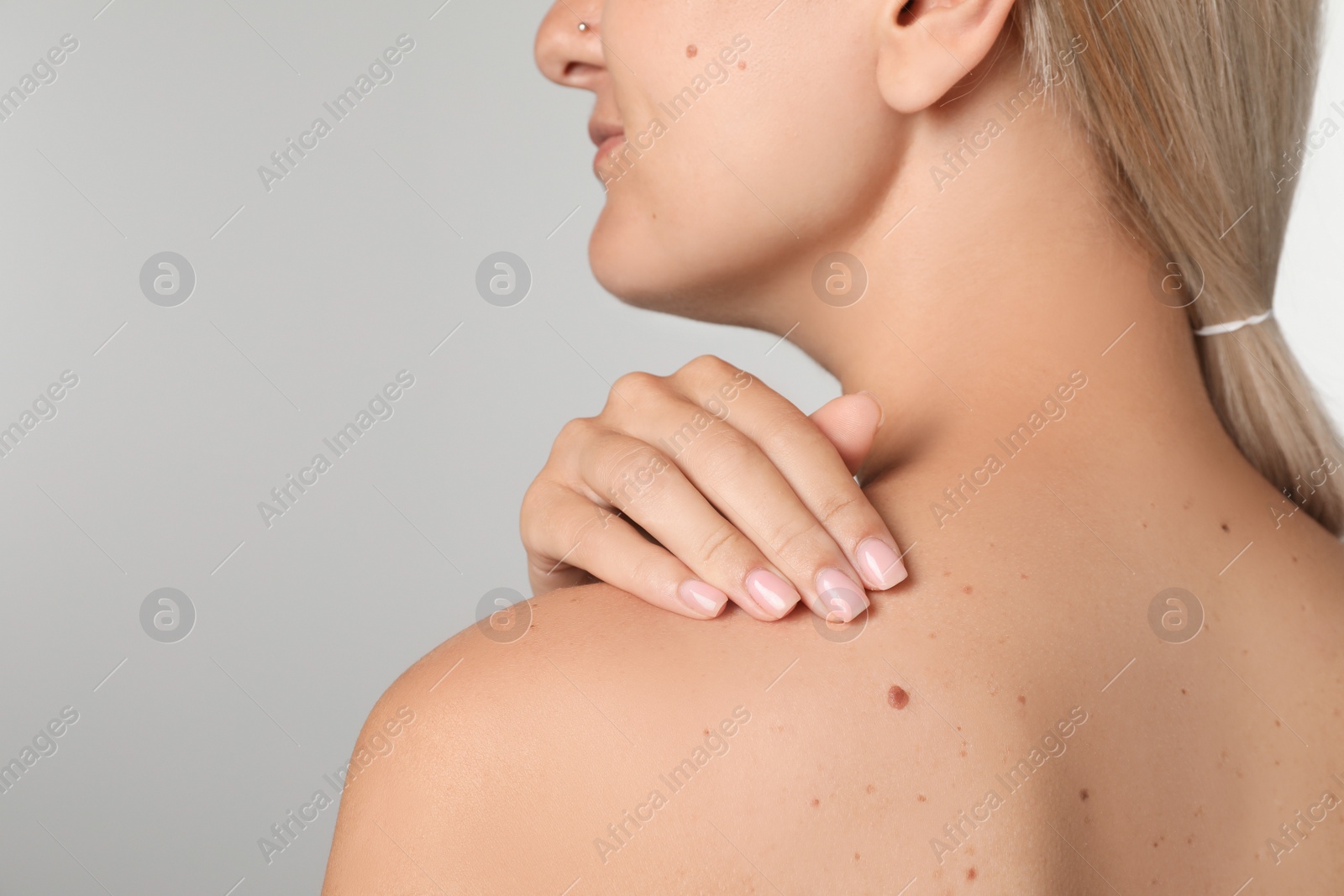 Photo of Closeup view of woman`s body with birthmarks on light grey background. Space for text
