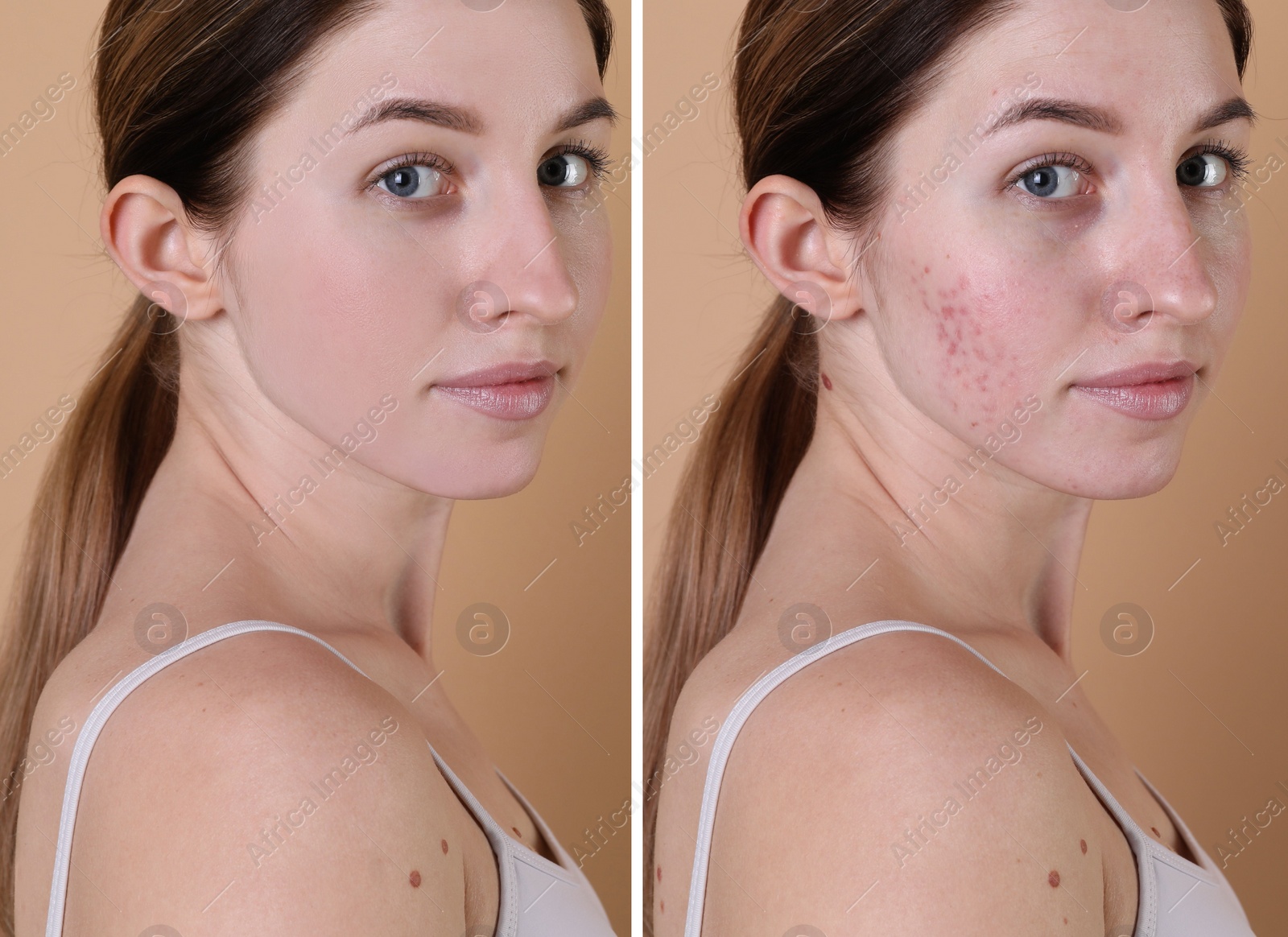 Image of Acne problem. Young woman before and after treatment on beige background, collage of photos