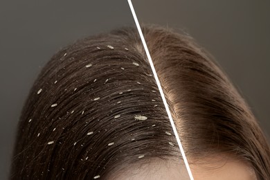 Image of Collage showing woman's hair before and after lice treatment on grey background, closeup. Suffering from pediculosis