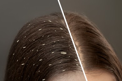 Collage showing woman's hair before and after lice treatment on grey background, closeup. Suffering from pediculosis