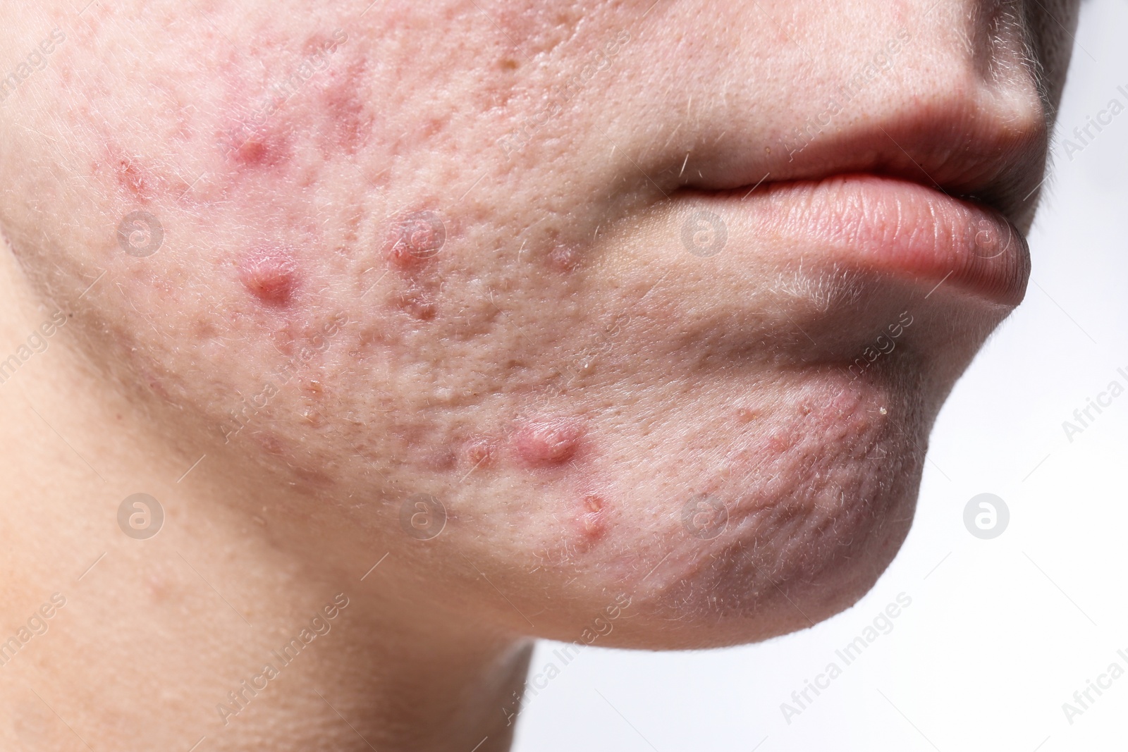 Photo of Young woman with acne on her face, closeup