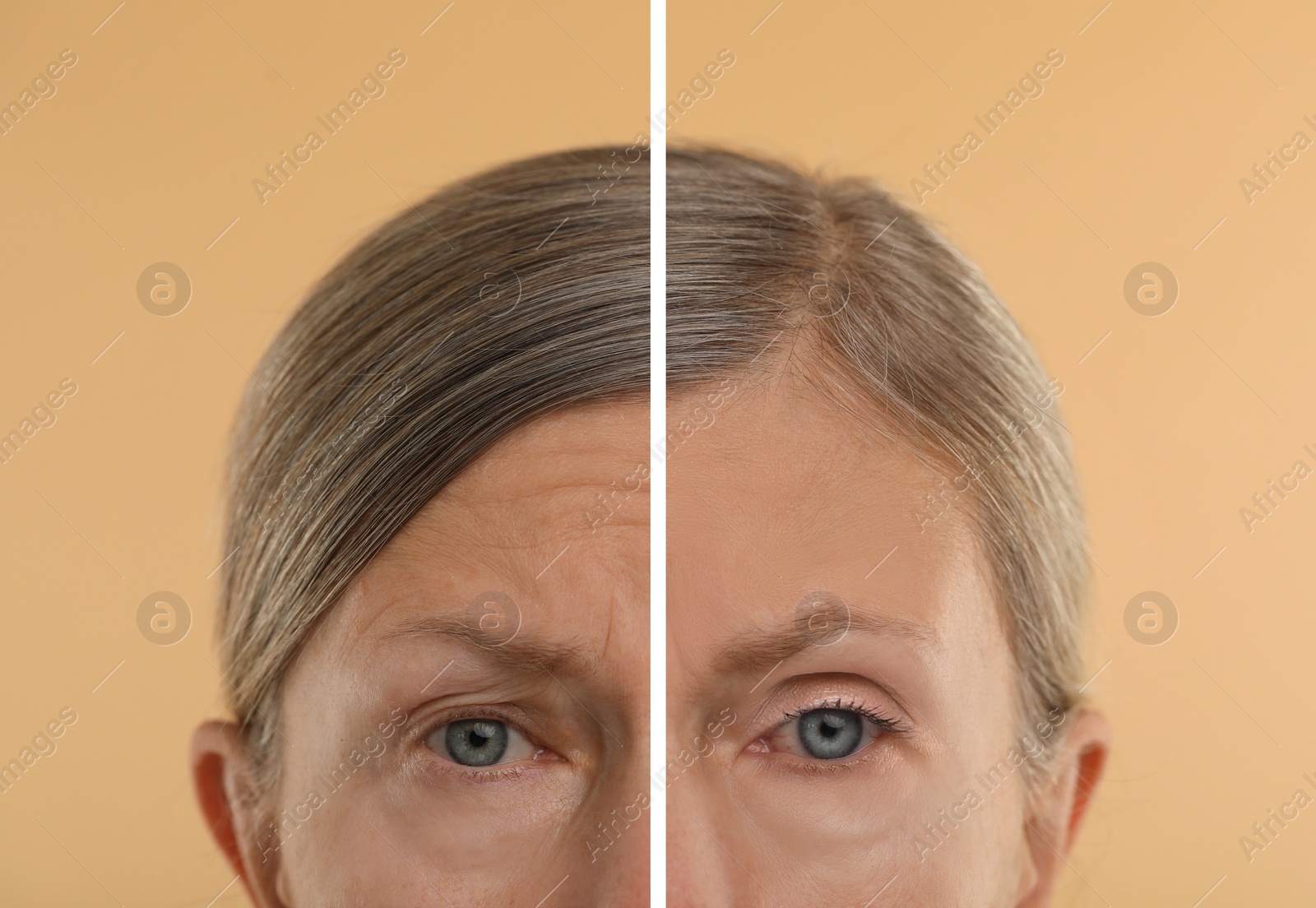 Image of Aging skin changes. Woman showing face before and after rejuvenation, closeup. Collage comparing skin condition