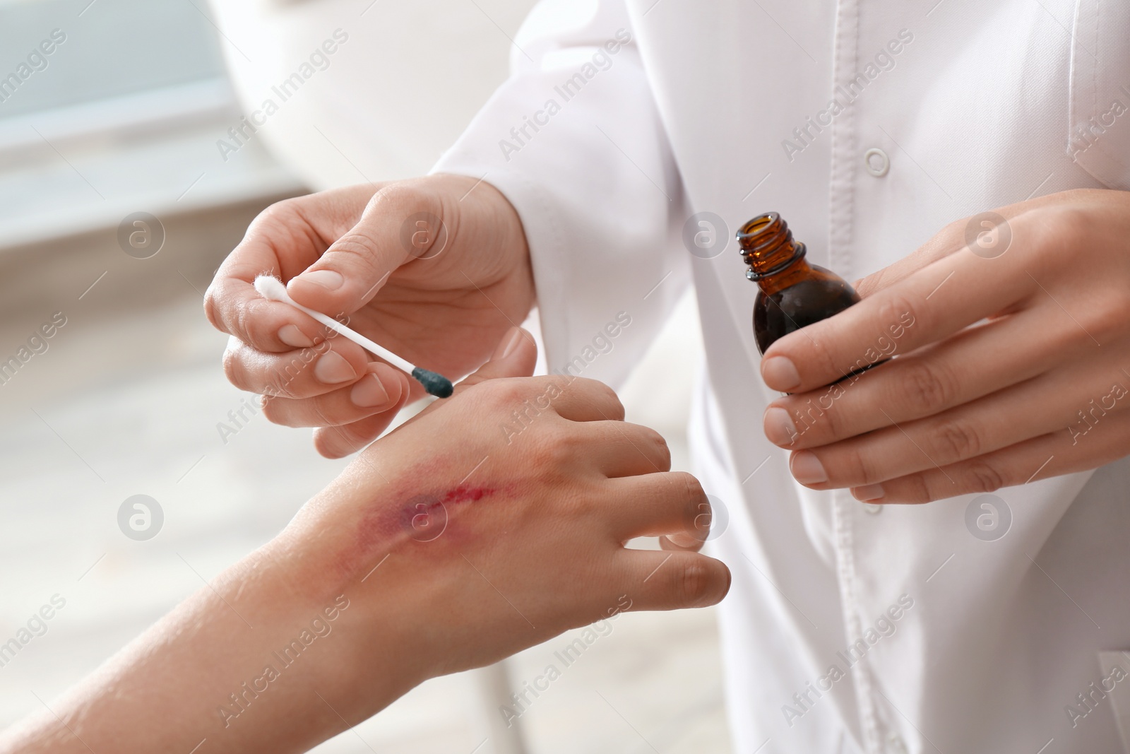 Photo of Doctor applying brilliant green onto injured hand indoors, closeup