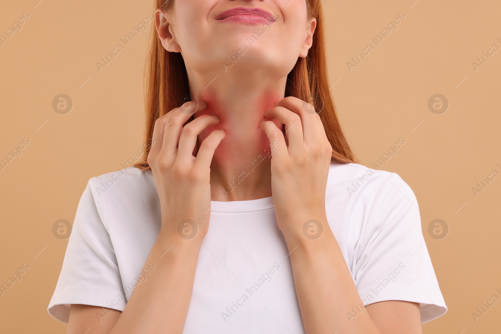 Photo of Suffering from allergy. Young woman scratching her neck on beige background, closeup