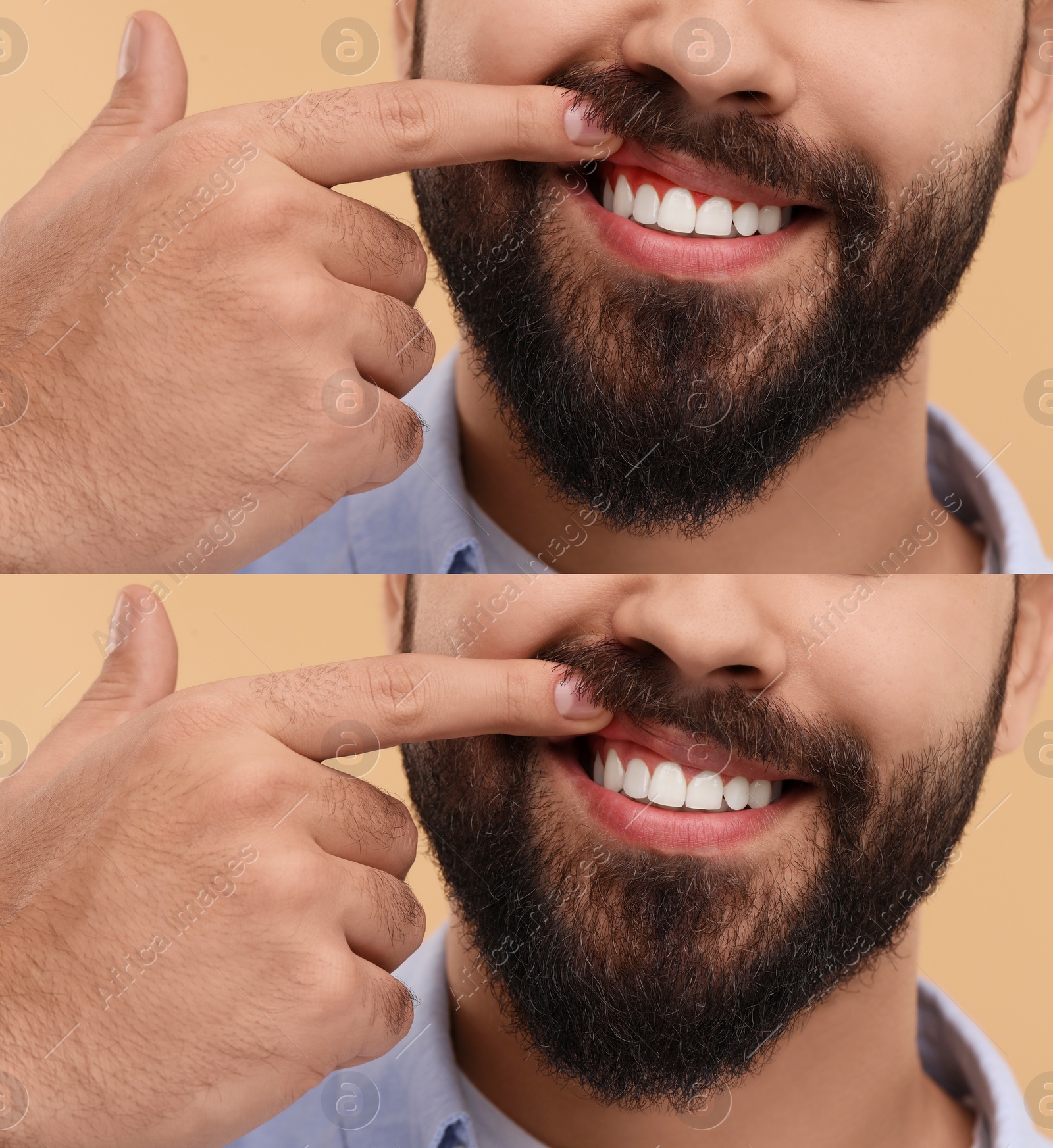 Image of Man showing gum before and after treatment on beige background, collage of photos