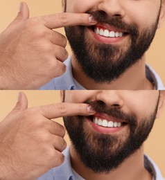 Man showing gum before and after treatment on beige background, collage of photos