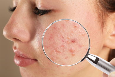 Image of Teenage girl with acne problem visiting dermatologist, closeup. Skin under magnifying glass