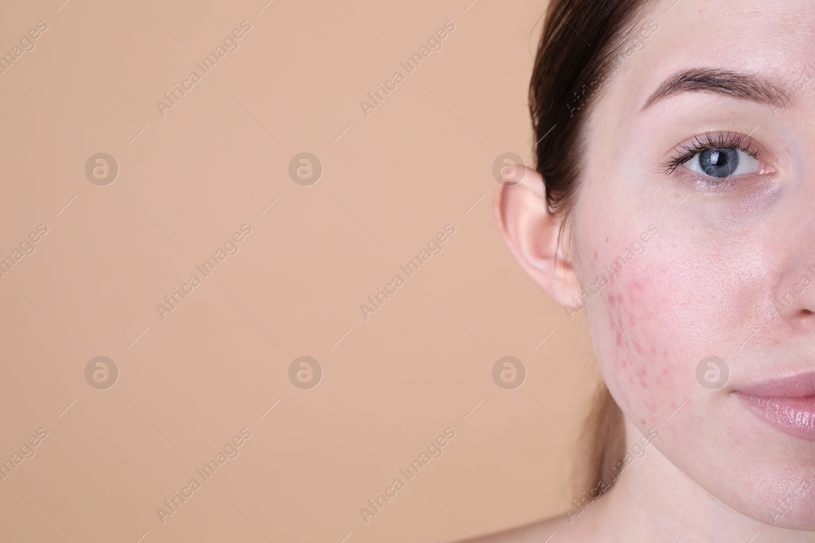 Photo of Young woman with acne problem on beige background. Space for text