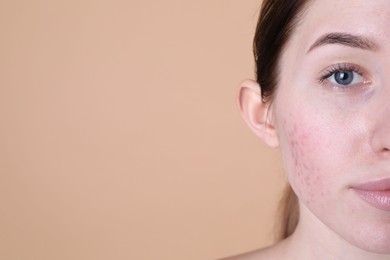 Photo of Young woman with acne problem on beige background. Space for text