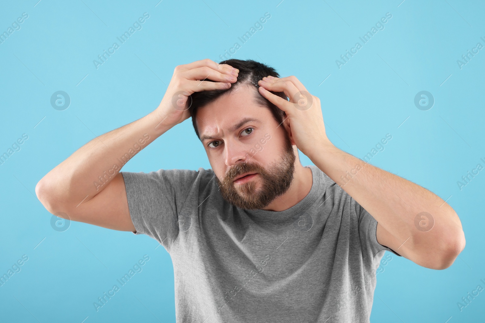 Photo of Man with dandruff in his dark hair on light blue background