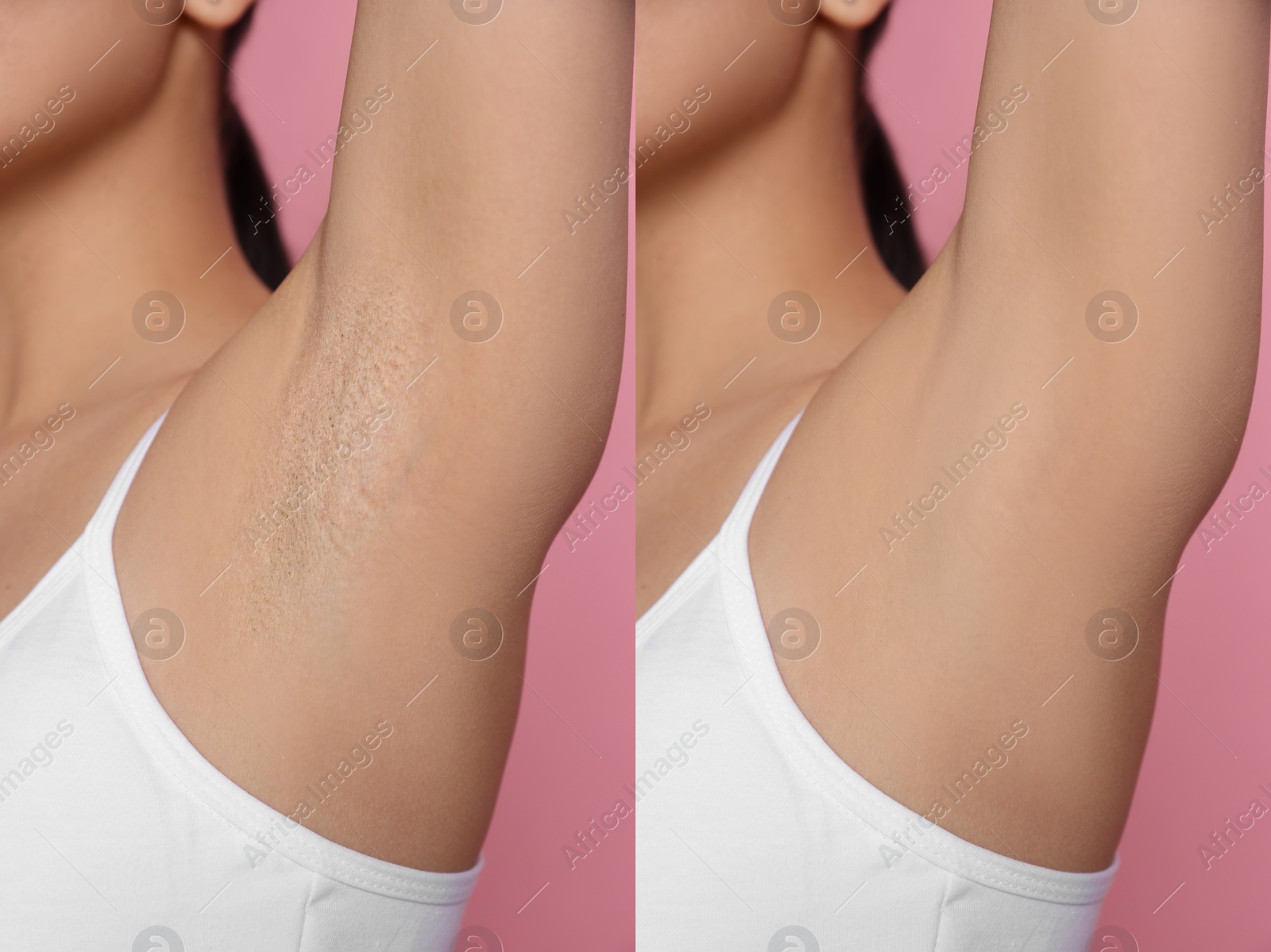 Image of Before and after epilation. Collage with photos of woman showing armpit on pink background, closeup