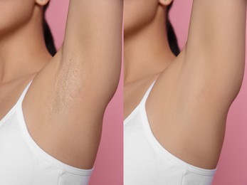 Image of Before and after epilation. Collage with photos of woman showing armpit on pink background, closeup