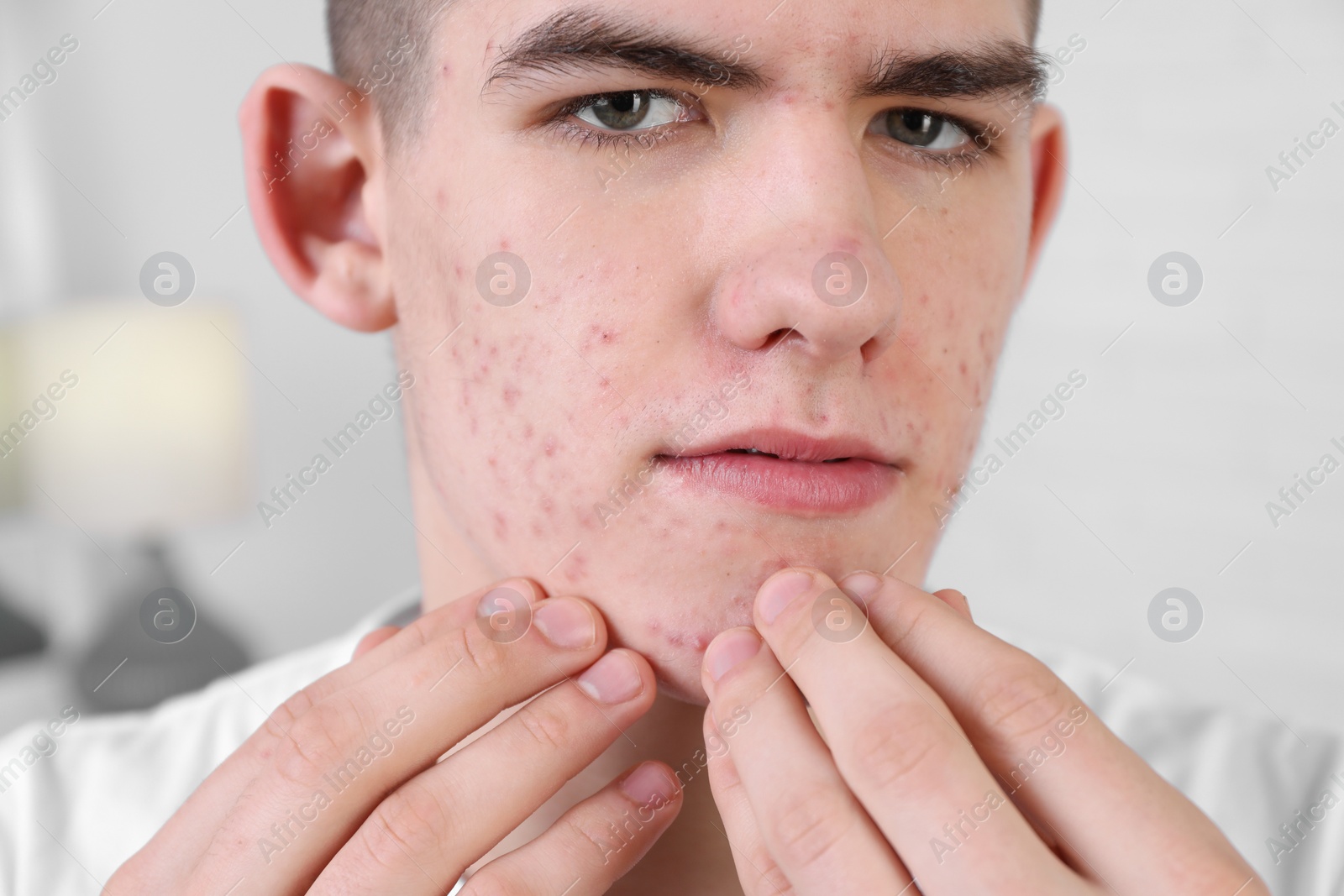 Photo of Young man touching pimple on his face indoors. Acne problem