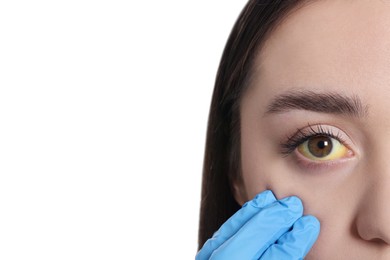 Doctor checking woman with yellow eyes on white background, closeup. Symptom of hepatitis