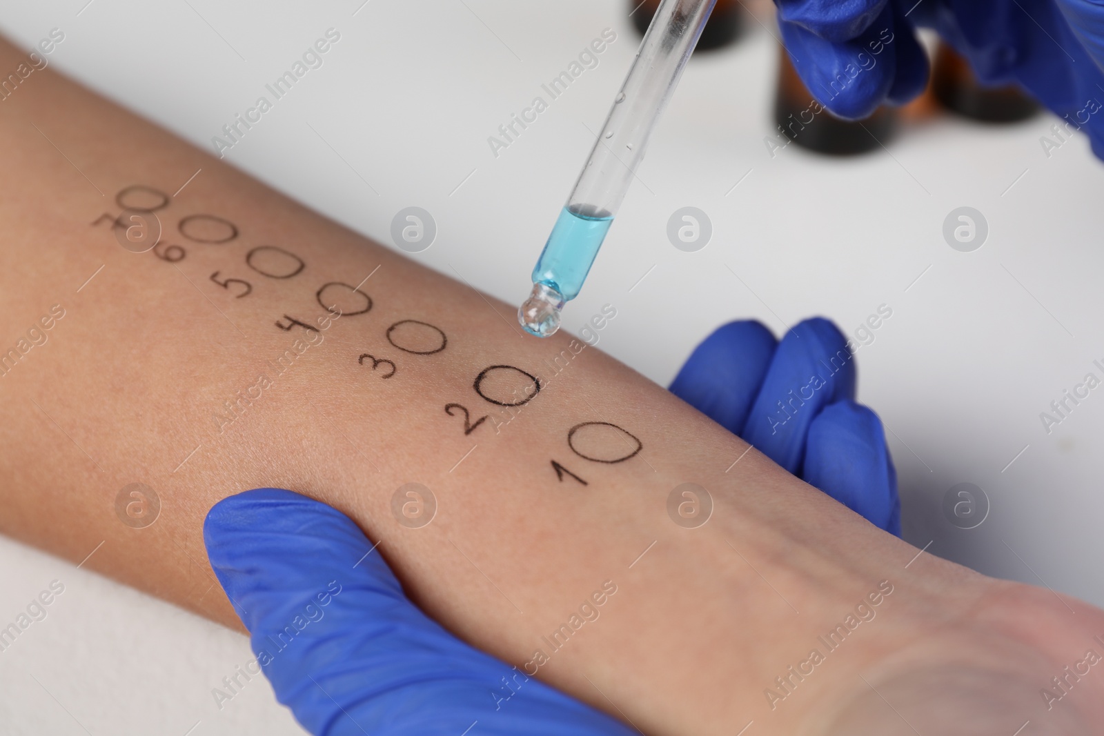 Photo of Doctor doing skin allergy test at light table, closeup