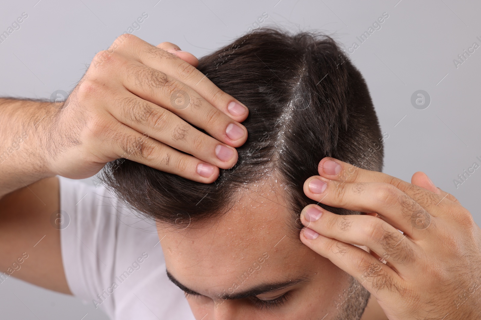 Photo of Man with dandruff in his dark hair on light grey background, closeup