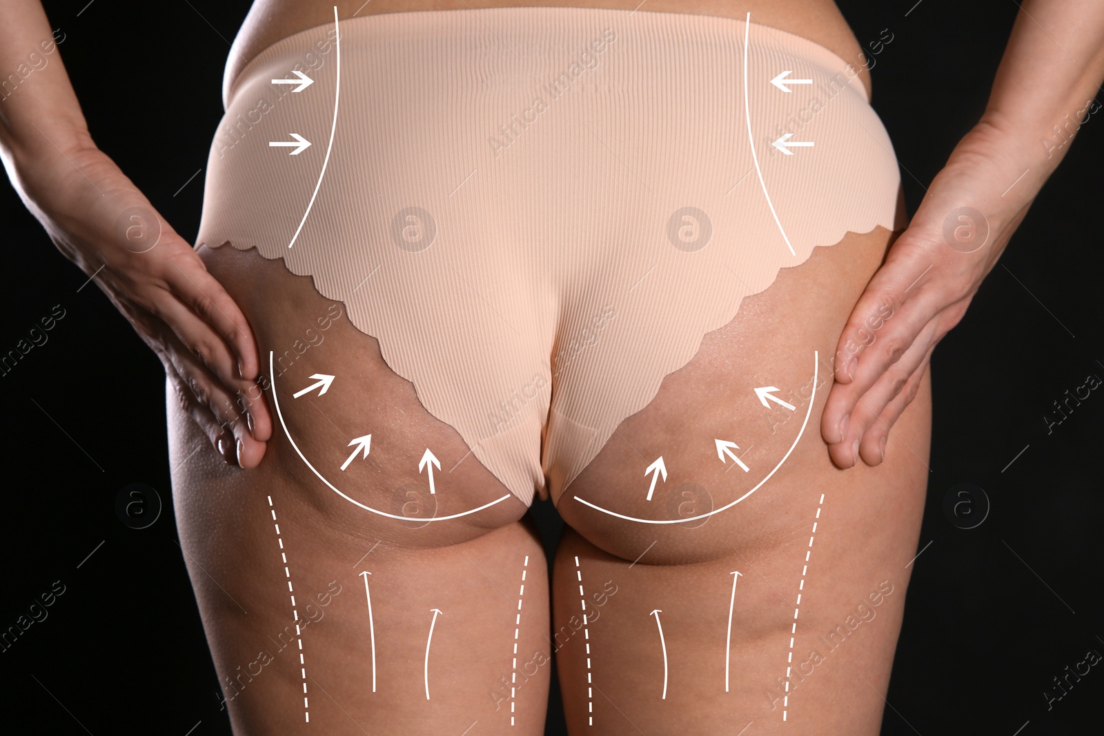 Image of Woman with marks on body before cosmetic surgery operation on black background, closeup
