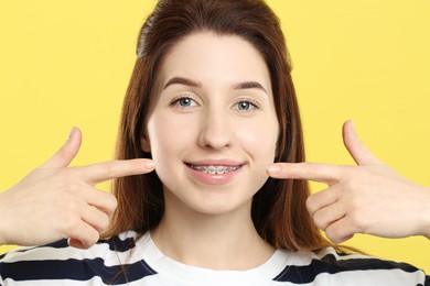 Smiling woman pointing at her dental braces on yellow background, closeup