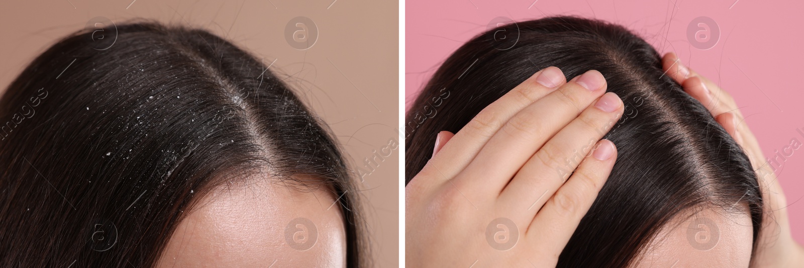 Image of Woman showing hair before and after dandruff treatment on color backgrounds, collage