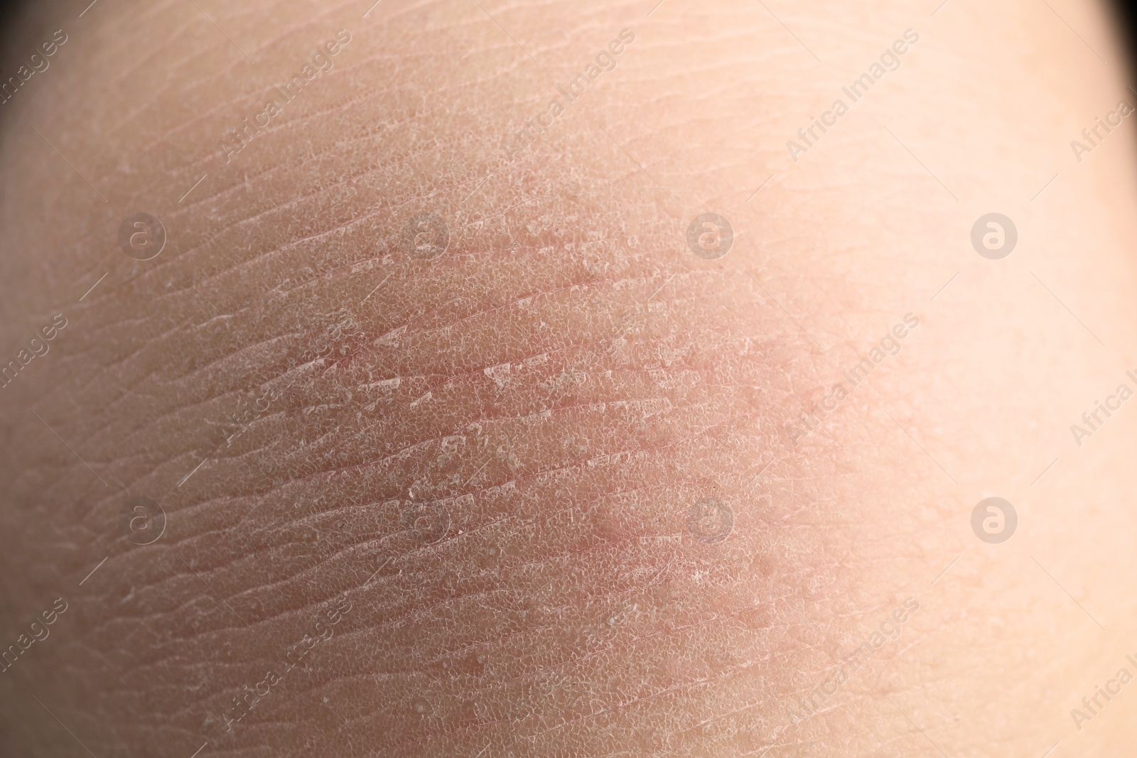 Photo of Closeup view of woman with dry skin
