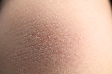 Closeup view of woman with dry skin